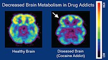 PET images showing brain metabolism in drug addicts vs controls