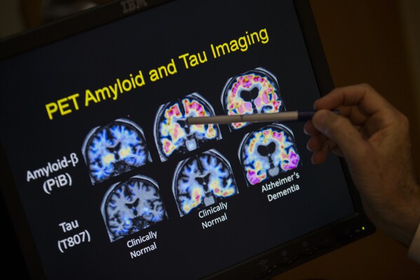 FILE - A doctor points to PET scan results that are part of a study on Alzheimer's disease at Georgetown University Hospital, on Tuesday, May 19, 2015, in Washington. (AP Photo/Evan Vucci, File)