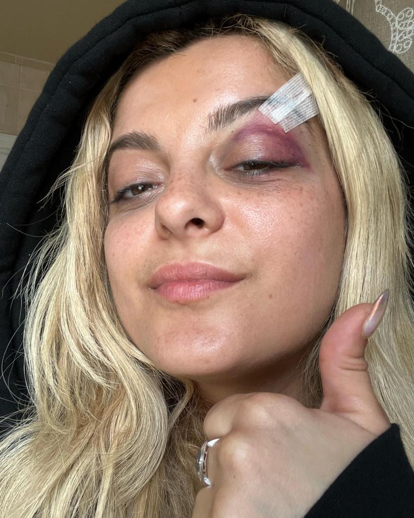 Bebe Rexha with a black eye. 