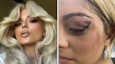 Bebe Rexha Shared Graphic Photos Of Her Injuries After A Man At Her Concert Threw His Phone At Her Face Amid...