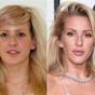 Ellie Goulding Lip Filler Before After